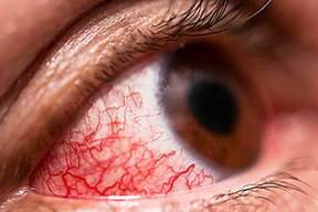 چشم‌های پر خون، نشانه‌ها و راه‌های درمان