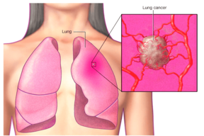 سرطان ریه: علایم، علل، فاکتورهای خطر و پیشگیری از آن