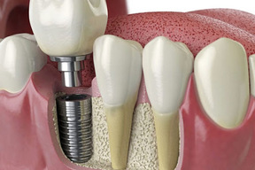سه نکته کلیدی درباره‌ی جراحی ایمپلنت دندان