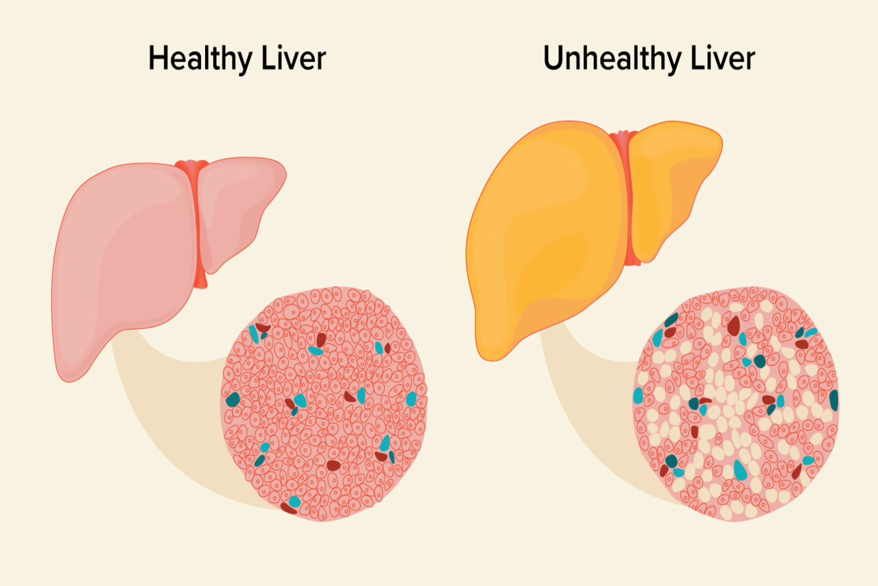 کبد چرب یا Fatty Liver چیست؟