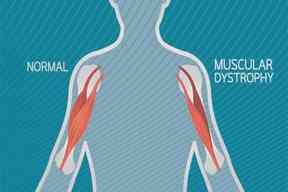 دیستروفی عضلانی دوشن چیست؟