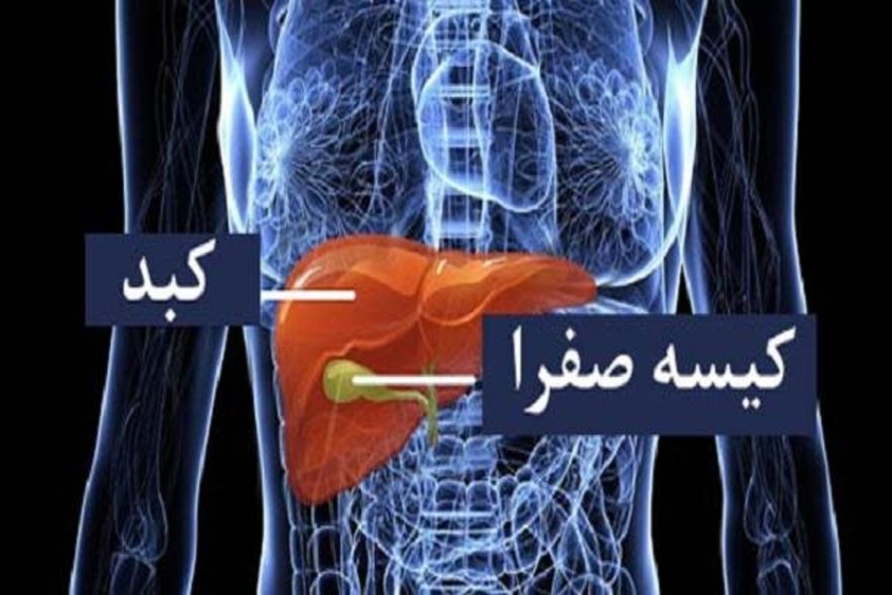 شایع ترین علامت و بهترین راه تشخیص سنگ کیسه صفرا