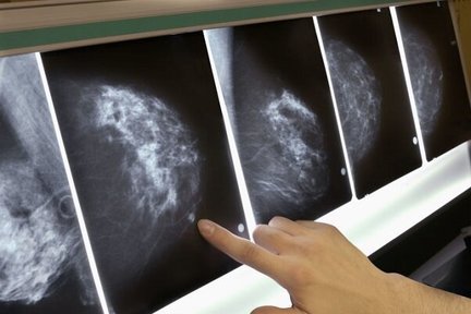 شناسایی فاکتور پرخطر احتمالی سرطان سینه