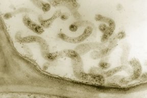 شناسایی یک باکتری که موجب بروز اِندومتریوز می شود