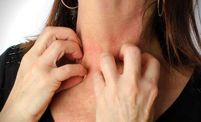 حساسیت پوستی به زیورآلات؛ درباره آلرژی به نیکل چه می دانید؟