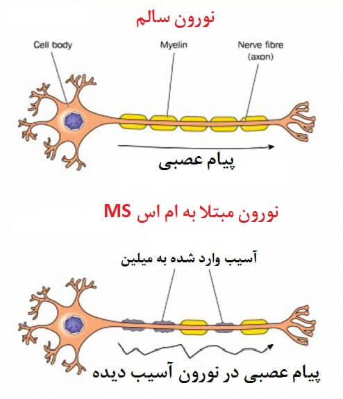 بیماری ام اس (MS) و علائم و نشانه های آن
