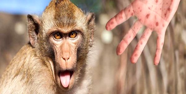 آیا آبله میمونی با کرونا ارتباط دارد/اقدامات کنترلی وزارت بهداشت