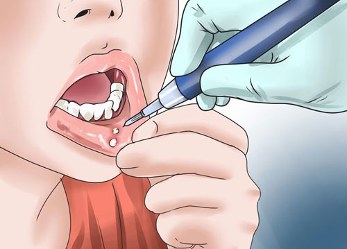 درمان های خانگی برای درمان آفت دهان