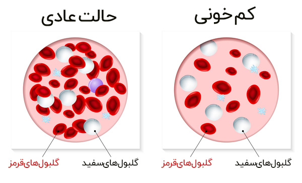 علائم کم خونی در هر فرد به چه گونه نمایان می شود؟