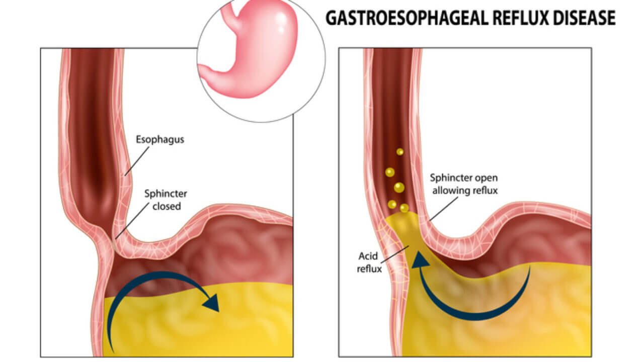 Gastroesophageal-Reflux-Disease - رفلاکس اسید معده به مری