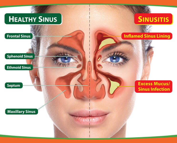 سینوزیت - Sinusitis
