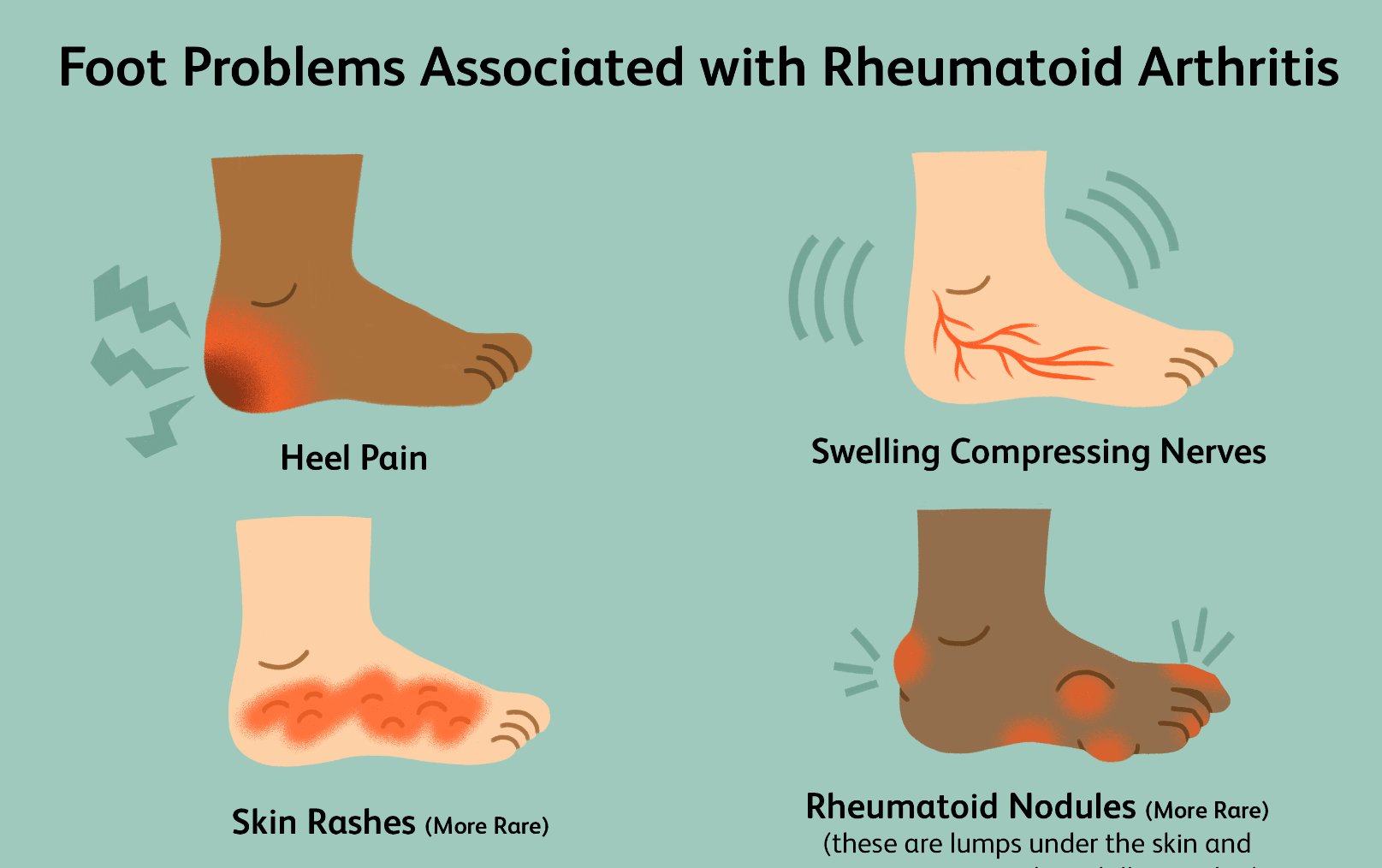 هر آنچه درمورد آرتریت روماتوئید باید بدانید