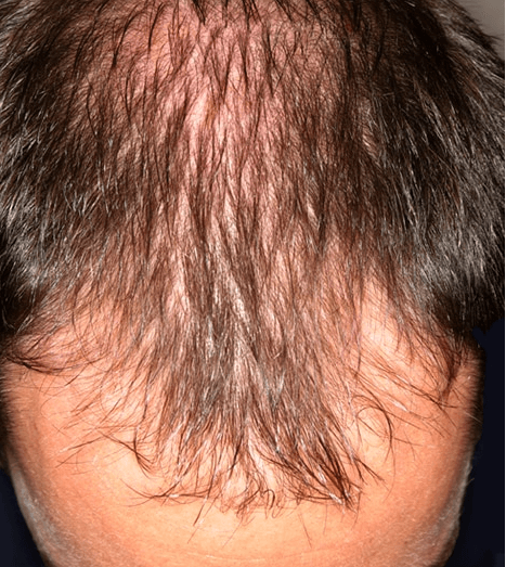 ریزش مو - hair loss
