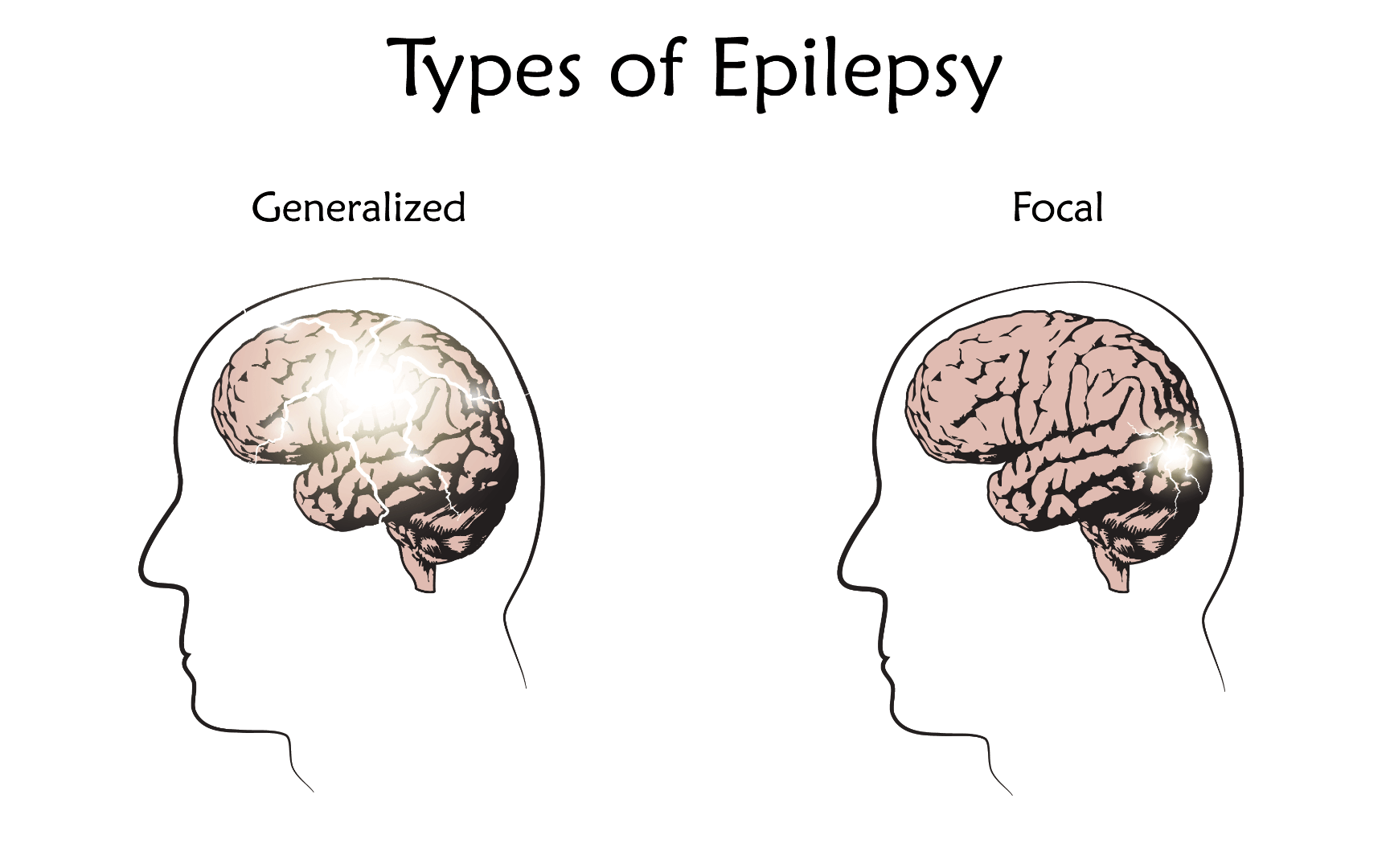 Фокальные припадки. Фокальная и генерализованная эпилепсия. Парциальные припадки эпилепсии. Фокальные эпилептические припадки. Эпилепсия мозг.